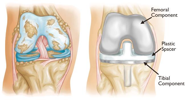 Knee implant specialist in delhi