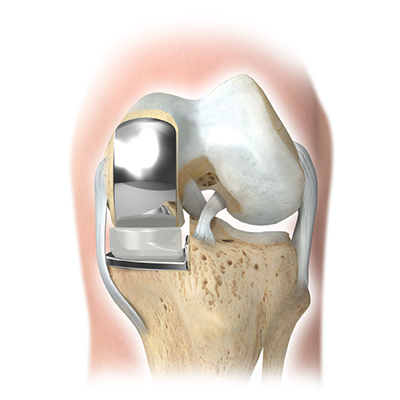 patial-knee-a Knee arthritis treatment