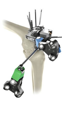 Computer Navigated Knee Replacement Surgery Computer Navigated Knee Replacement Surgery