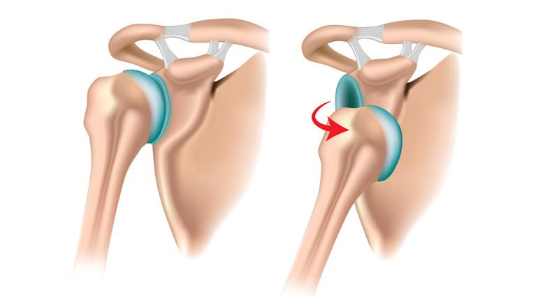 Shoulder dislocation surgery in Delhi